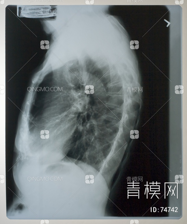 X射线-胸部贴图下载【ID:74742】