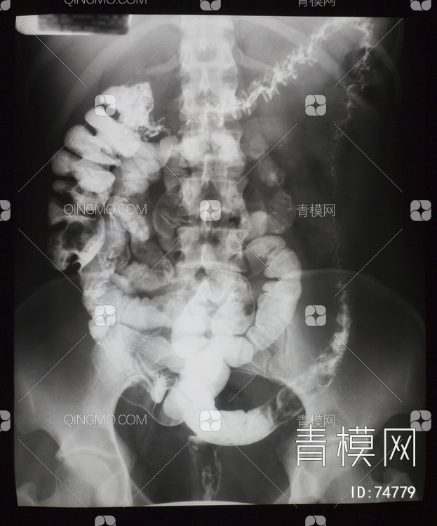 X射线-盆腔贴图下载【ID:74779】