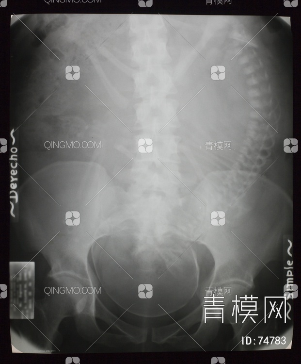 X射线-盆腔贴图下载【ID:74783】
