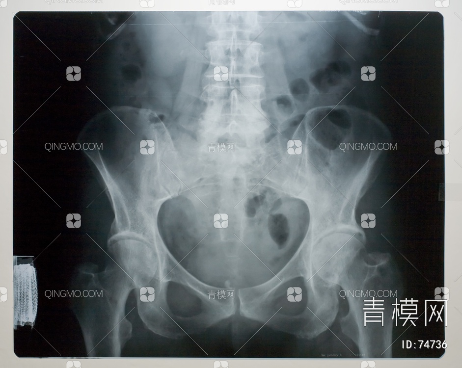 X射线-盆腔贴图下载【ID:74736】