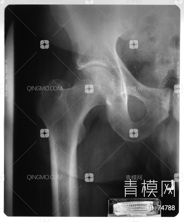 X射线-盆腔贴图下载【ID:74788】