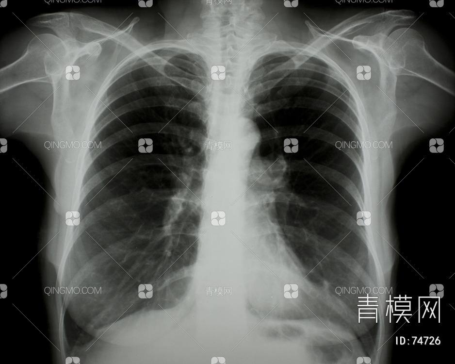 X射线-胸部贴图下载【ID:74726】