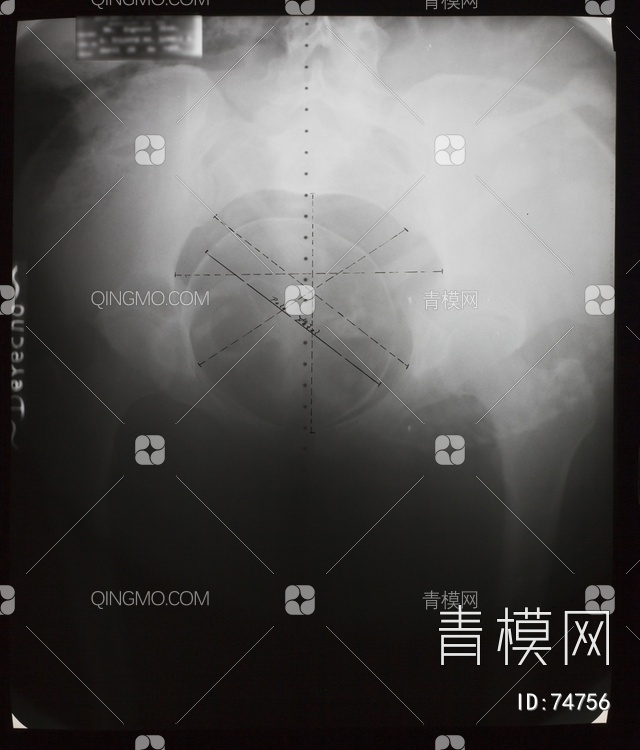 X射线-盆腔贴图下载【ID:74756】
