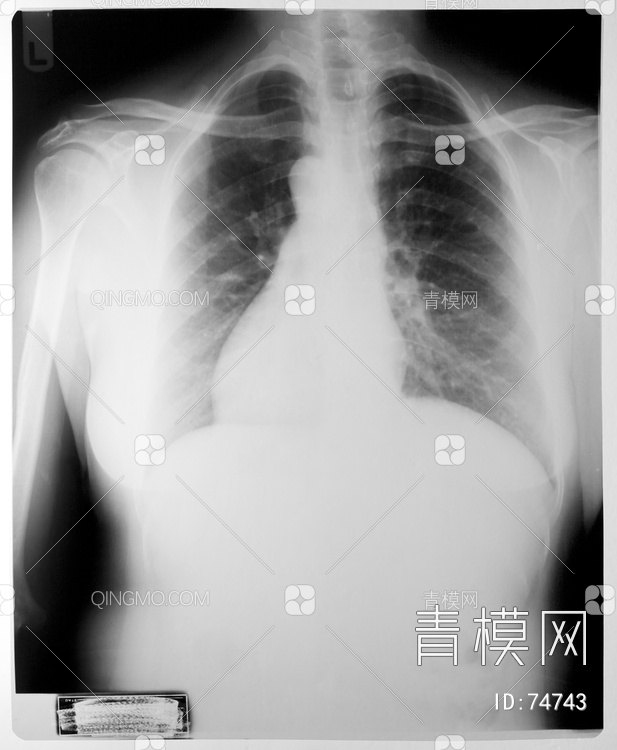X射线-胸部贴图下载【ID:74743】