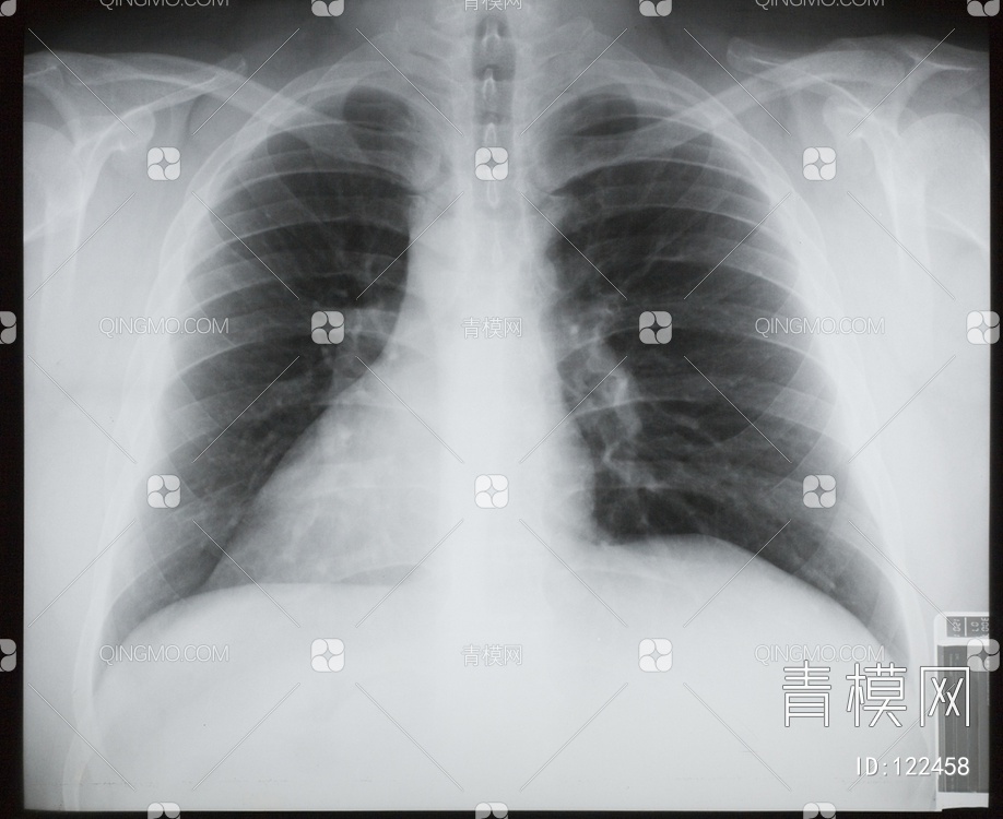 胸部X射线贴图下载【ID:122458】