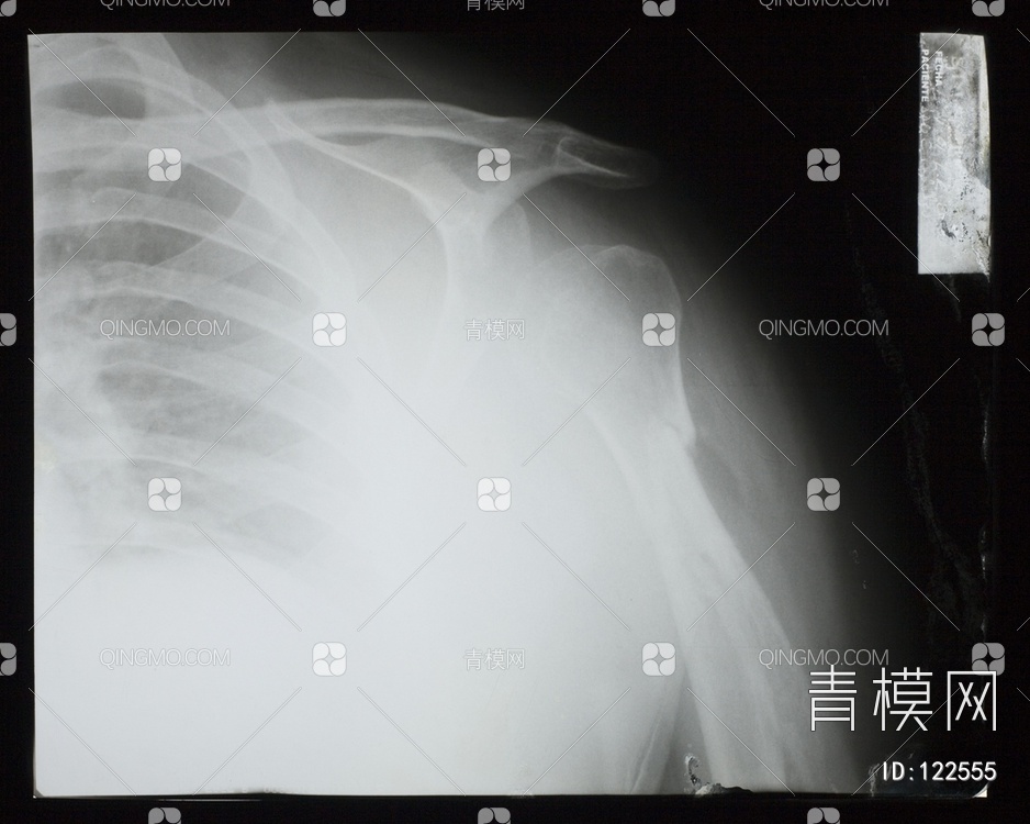 肩X射线贴图下载【ID:122555】