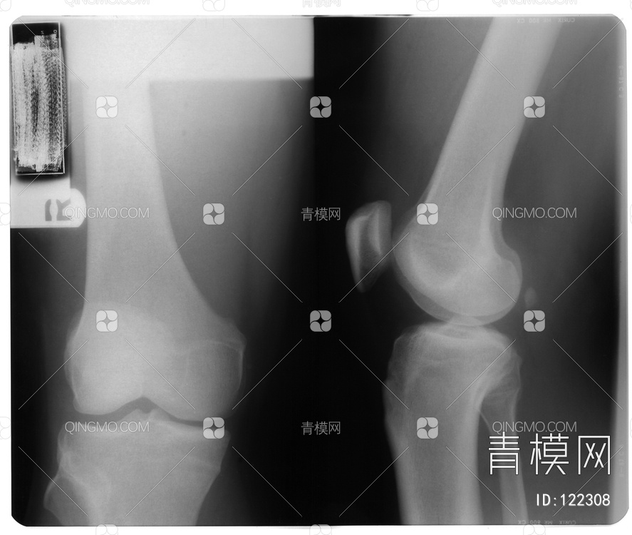 膝关节X射线贴图下载【ID:122308】
