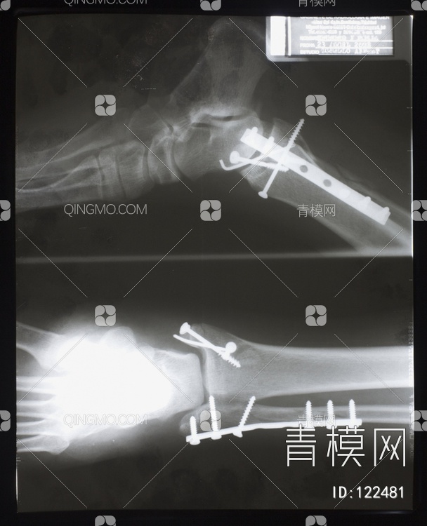 脚X射线贴图下载【ID:122481】