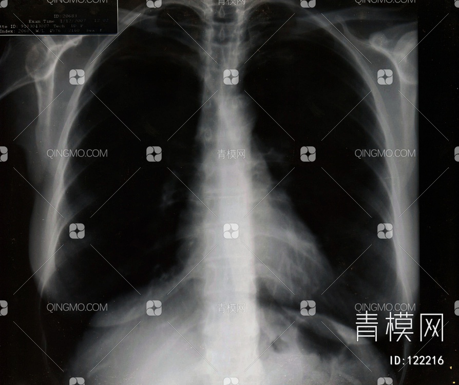 胸部X射线贴图下载【ID:122216】