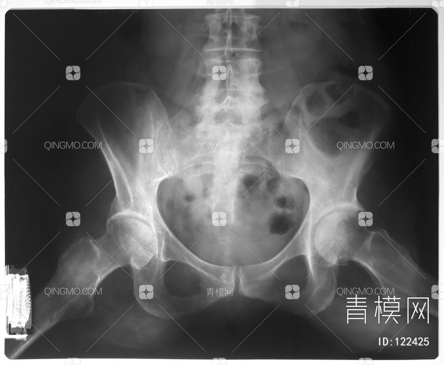盆腔X射线贴图下载【ID:122425】