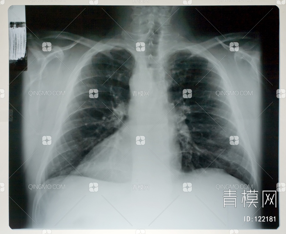 胸部X射线贴图下载【ID:122181】