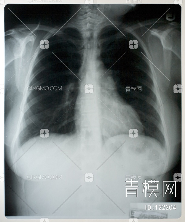 胸部X射线贴图下载【ID:122204】