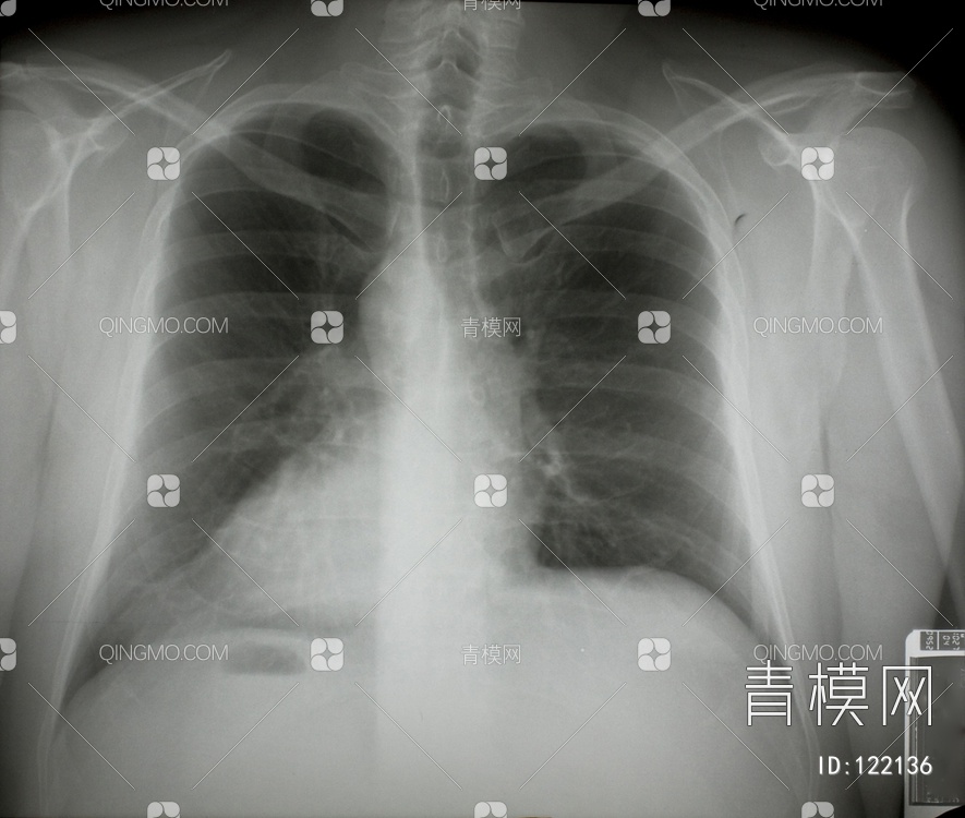 胸部X射线贴图下载【ID:122136】