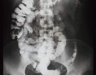 X射线-盆腔