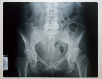 X射线-盆腔