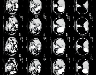 X射线-CT磁共振成像