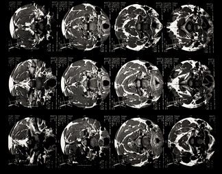 X射线-CT磁共振成像