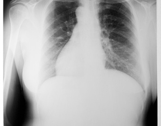 X射线-胸部