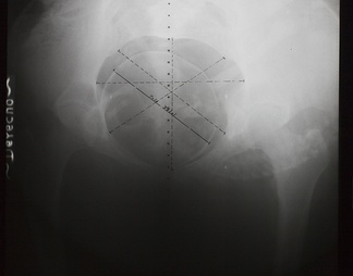盆腔X射线