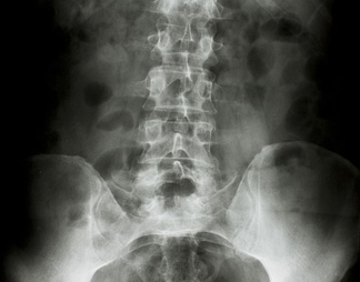 盆腔X射线