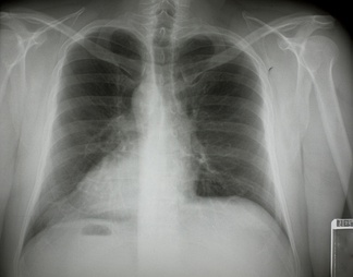 胸部X射线