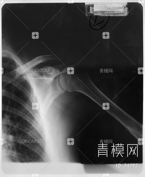 X射线-肩
