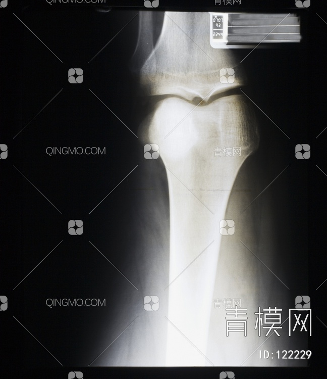 膝关节X射线
